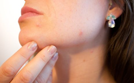 woman's face with acne